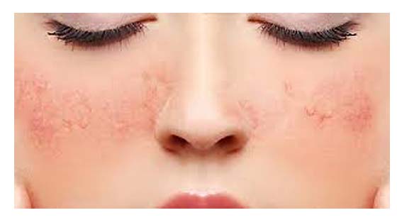 Método não invasivo e indolor para tratar varizes na face